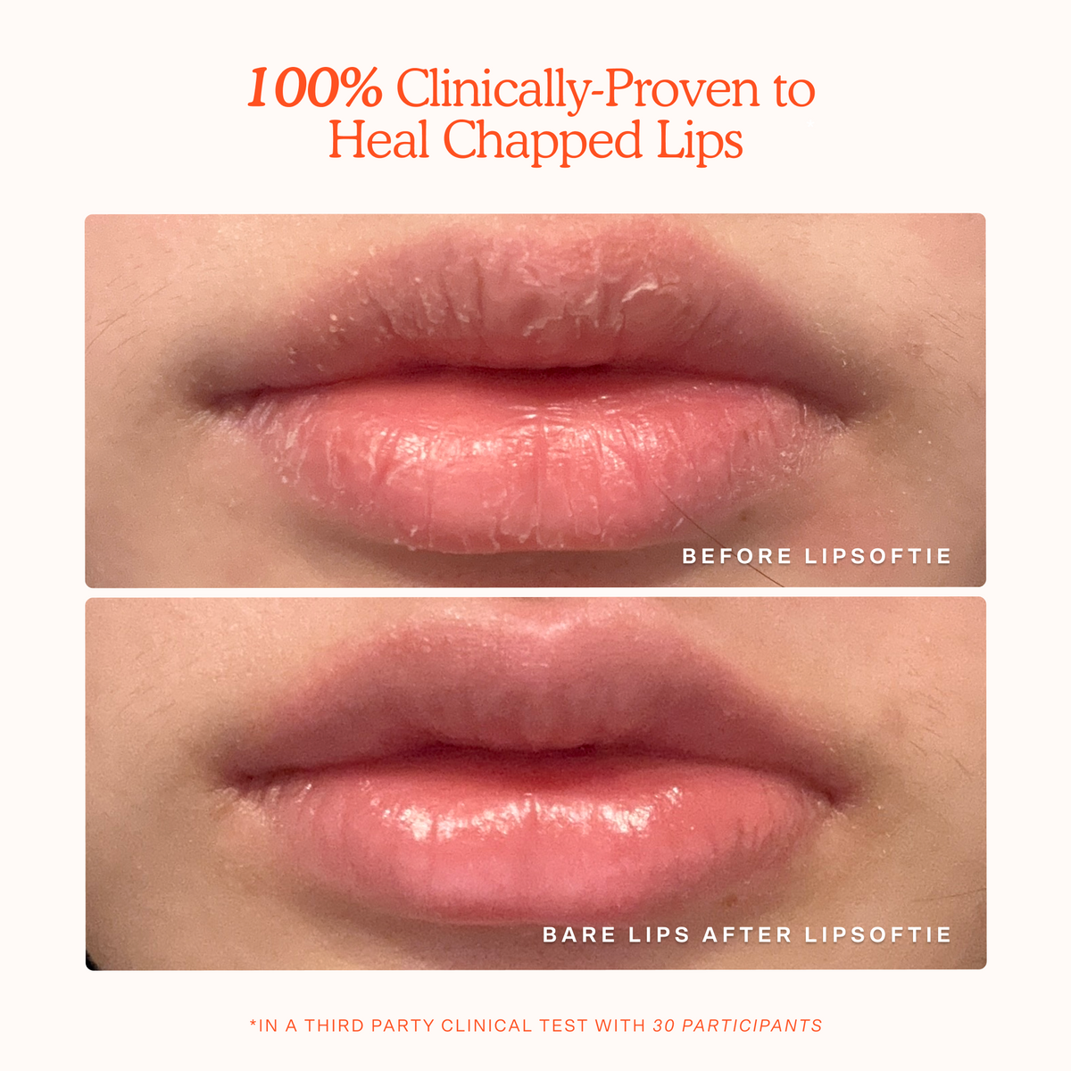 LipSoftie® Lip Treatment L0