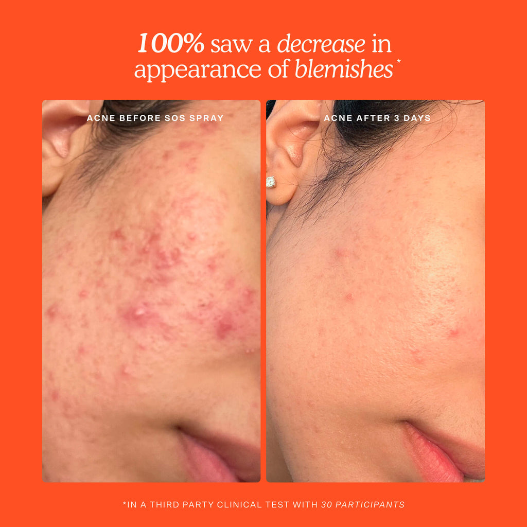 SOS 3-Step Skincare Set I2