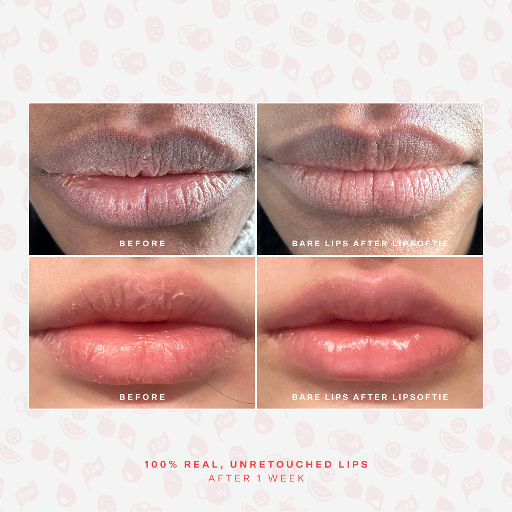 SOS LipSoftie® Lip Treatment I3