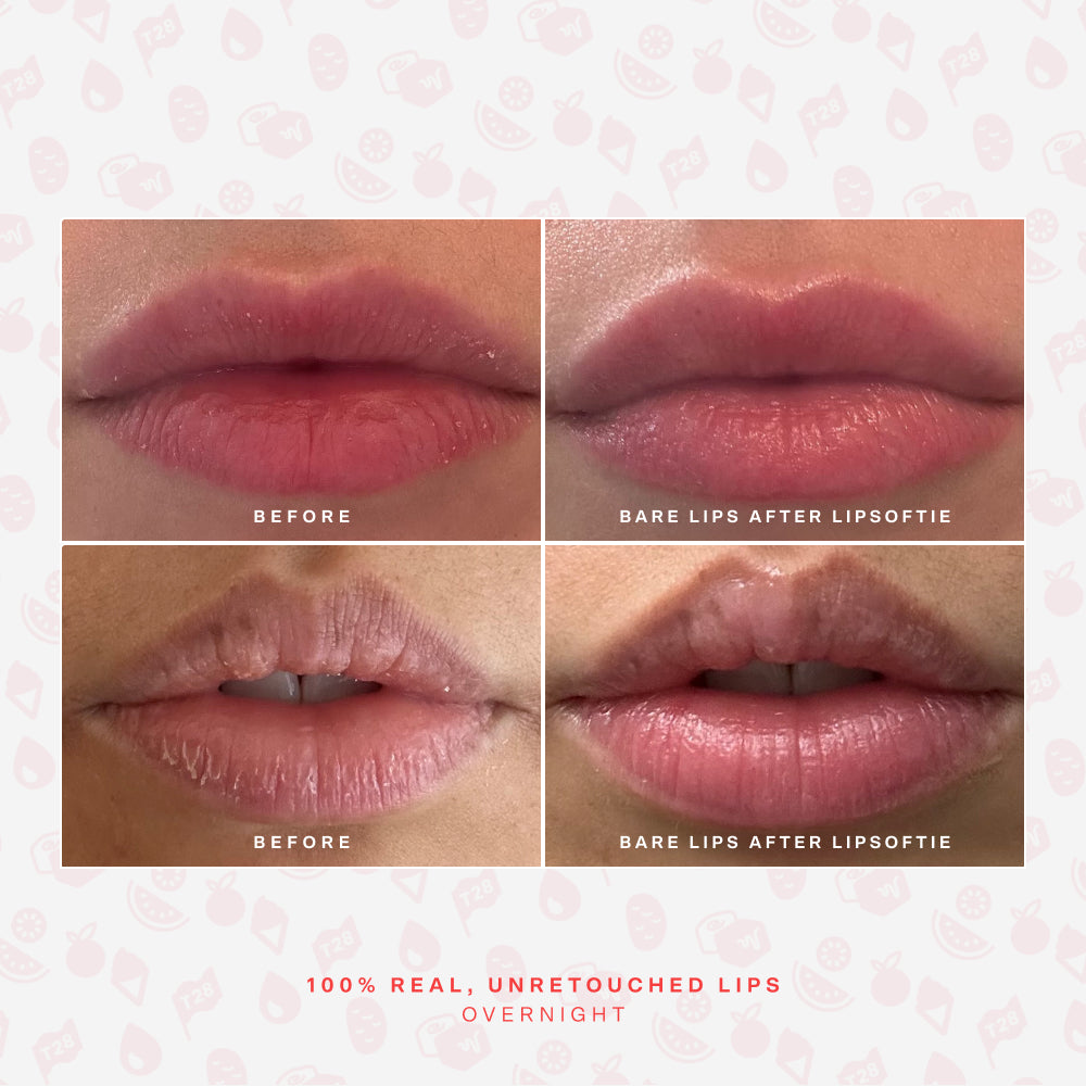 SOS LipSoftie® Lip Treatment H9